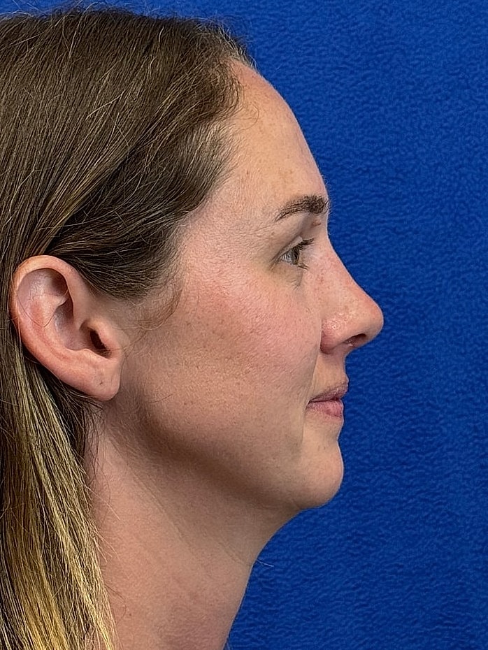 Rhinoplasty Before & After