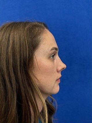 Rhinoplasty Before & After