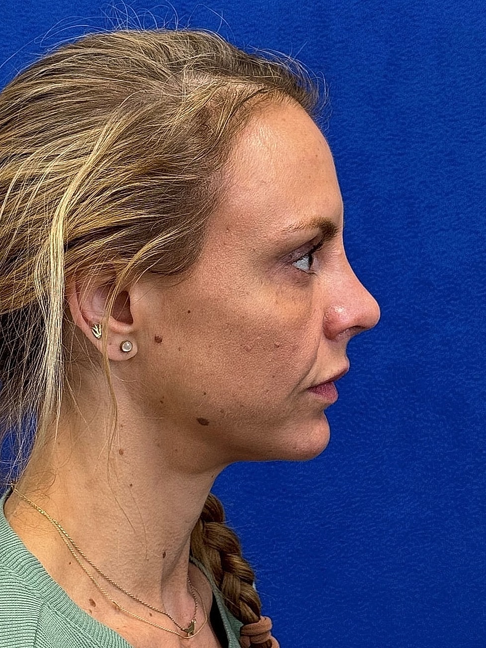 Rhinoplasty Before & After
