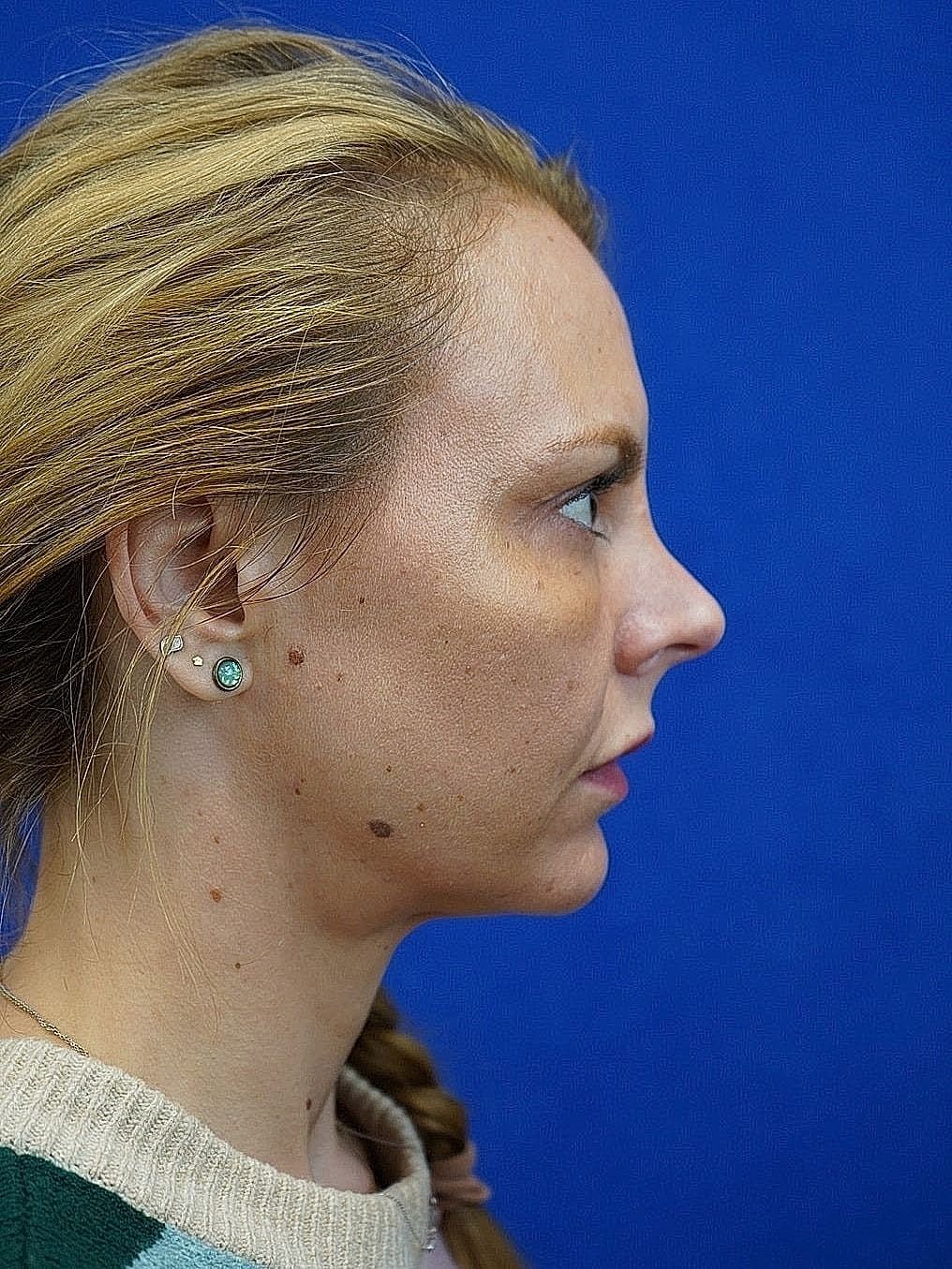 Rhinoplasty Before & After